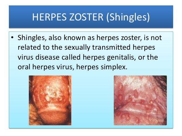 herpes zoster behandeling